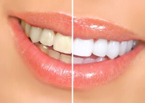 Before/after shot of teeth that were stained and then whitened